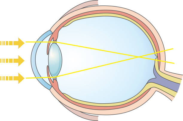 Diagram showing axial length and elongation in a myopic eye